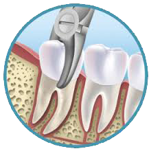 tooth extraction arekere,bannerghatta road