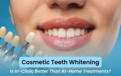 Cosmetic Teeth Whitening: Is In-Clinic Better Than At-Home Treatments?