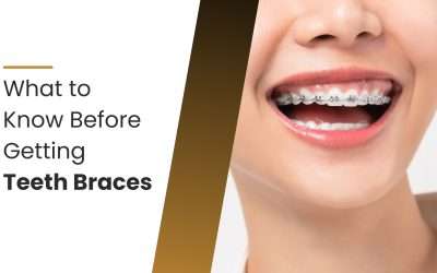 What to Know Before Getting Teeth Braces