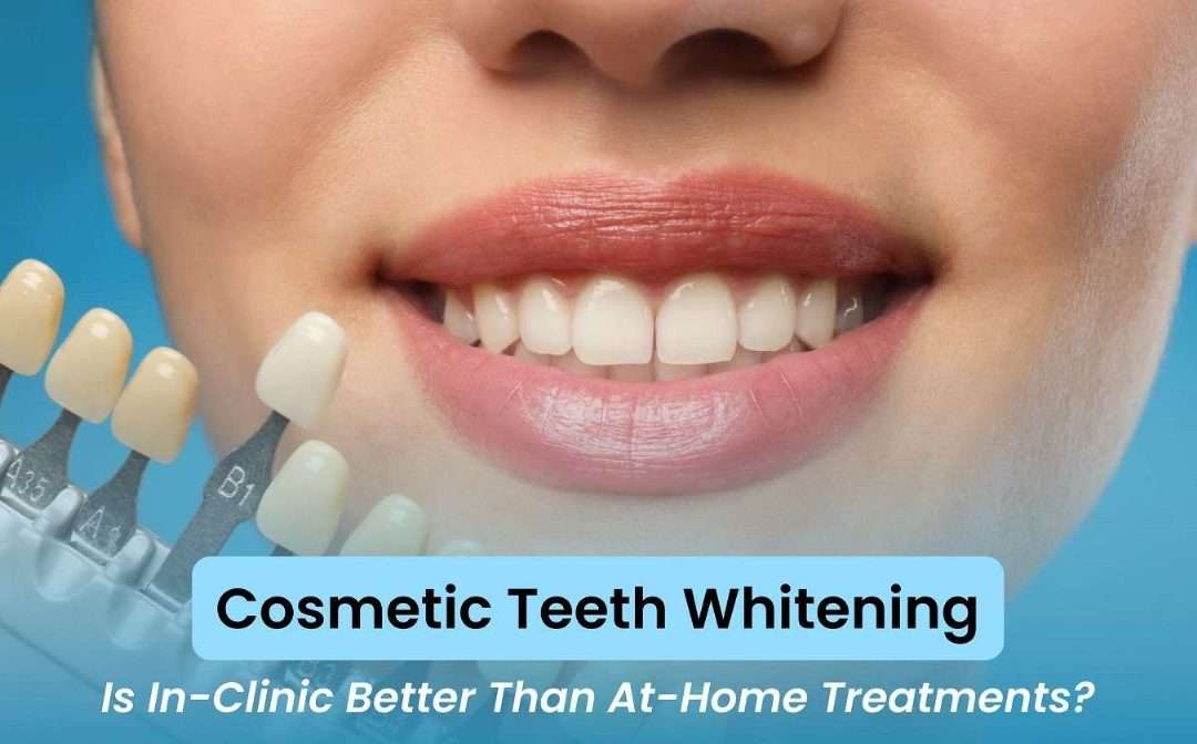 Cosmetic Teeth Whitening: Is In-Clinic Better Than At-Home Treatments?