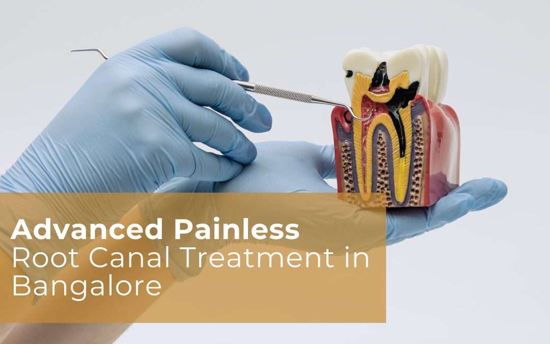 Advanced Painless Root Canal Treatment in Bangalore