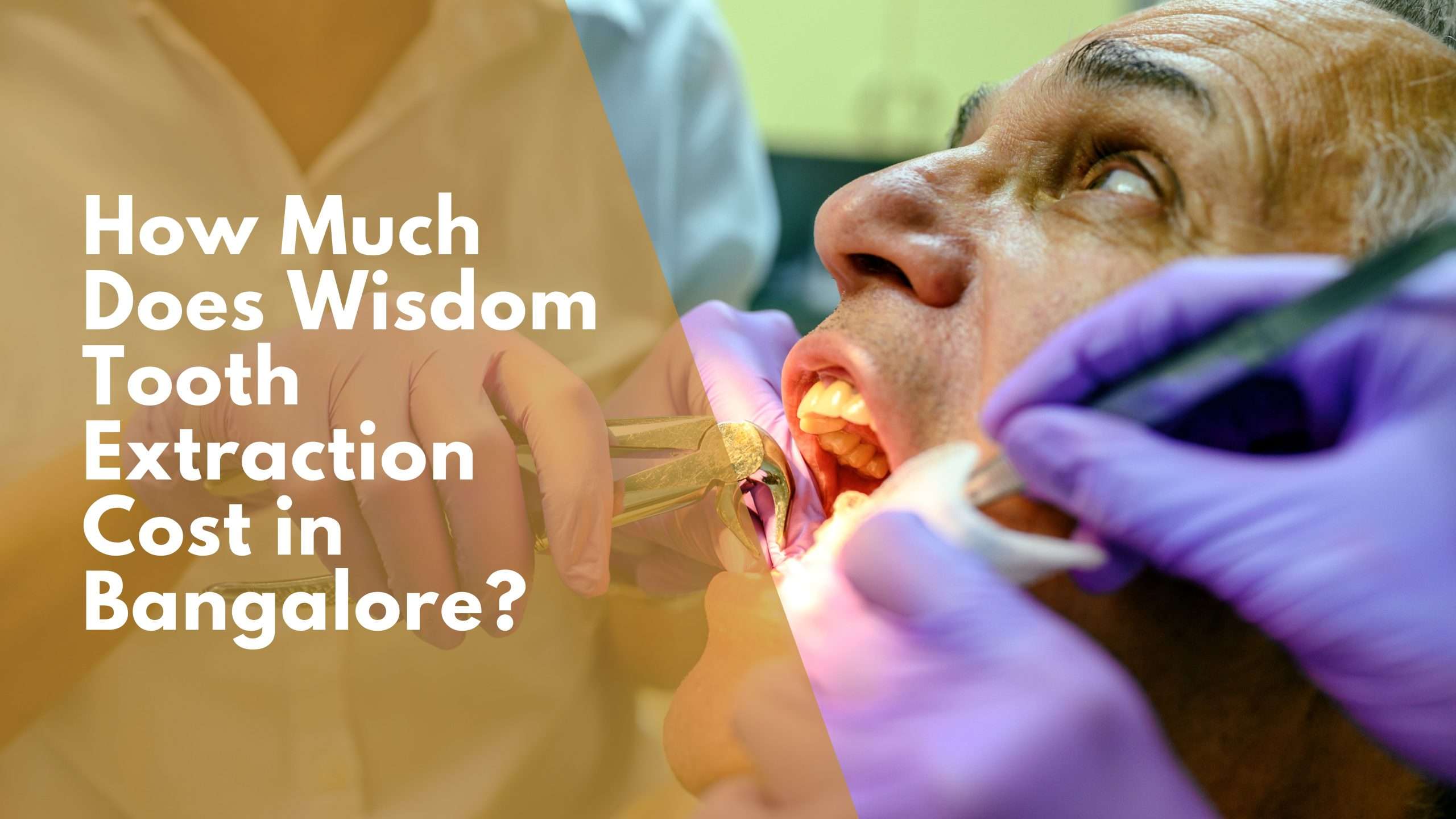 How Much Does Wisdom Tooth Extraction Cost in Bangalore?
