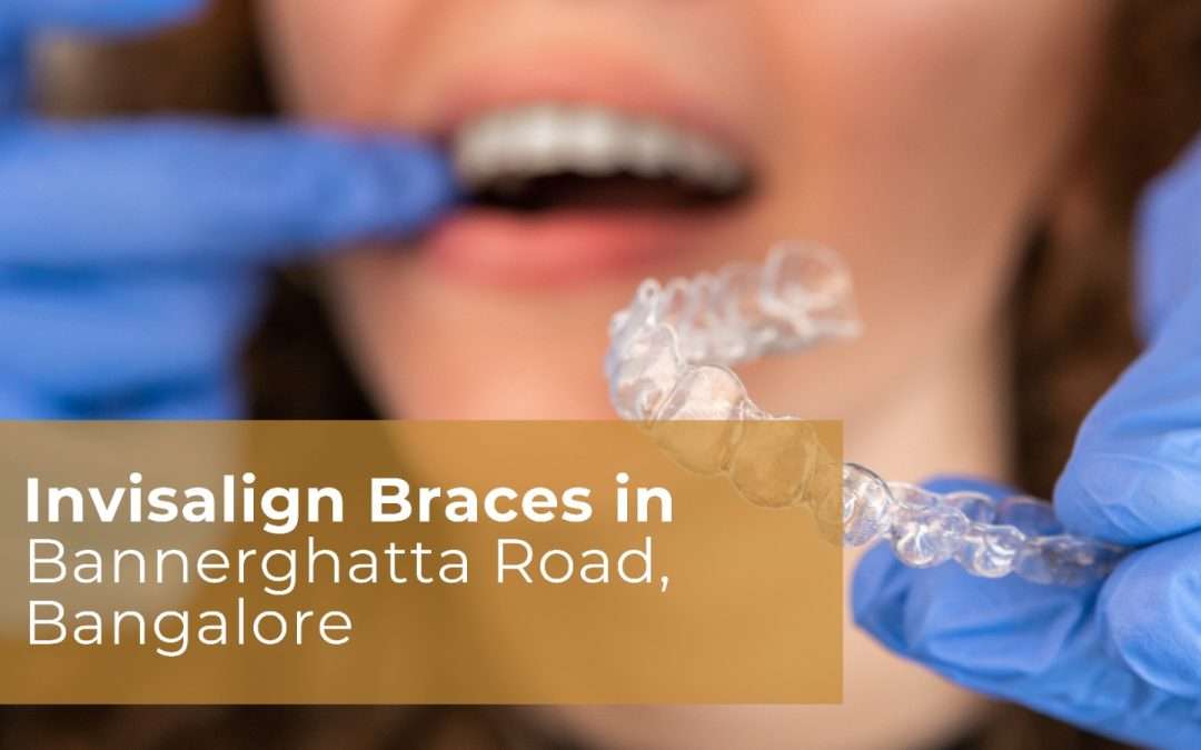 Invisalign Braces in Bannerghatta Road, Bangalore