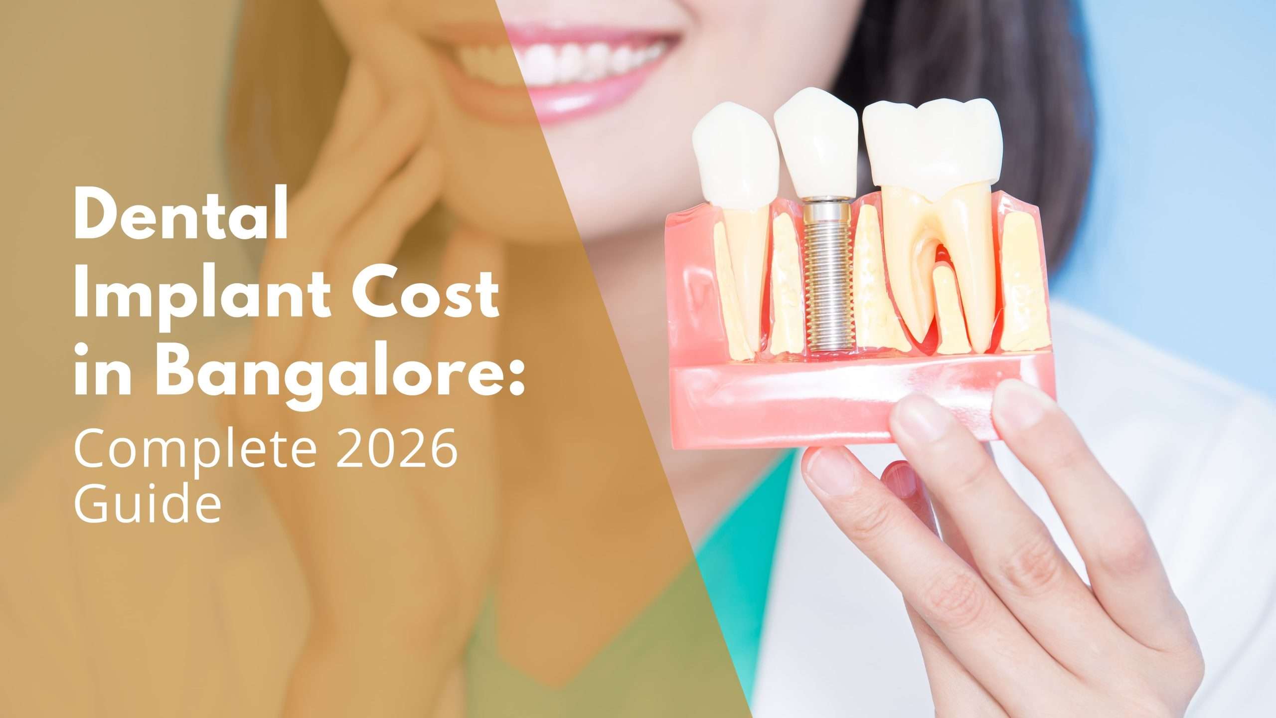 Dental Implant Cost in Bangalore: Complete 2026 Guide