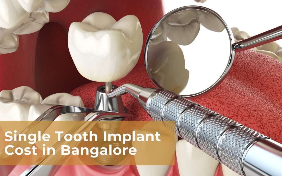 Single Tooth Implant Cost in Bangalore