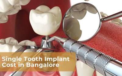 Single Tooth Implant Cost in Bangalore