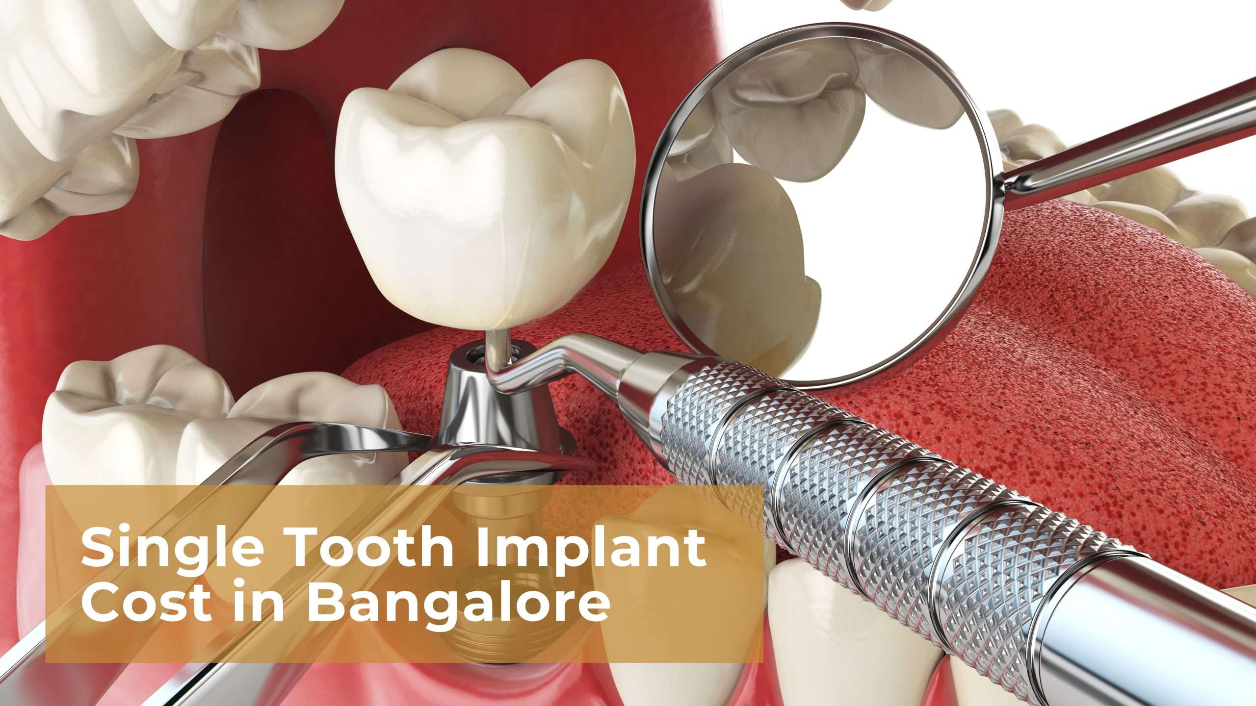 Single Tooth Implant Cost in Bangalore