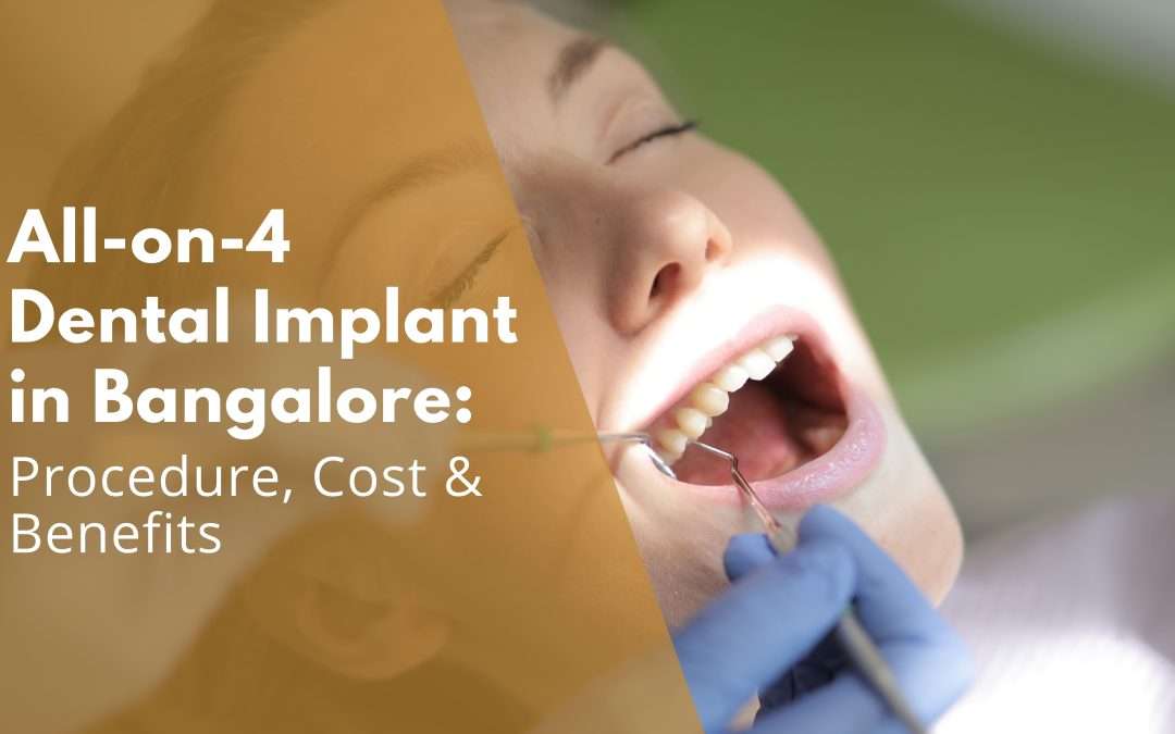 Full Mouth Dental Implants Cost in Bangalore