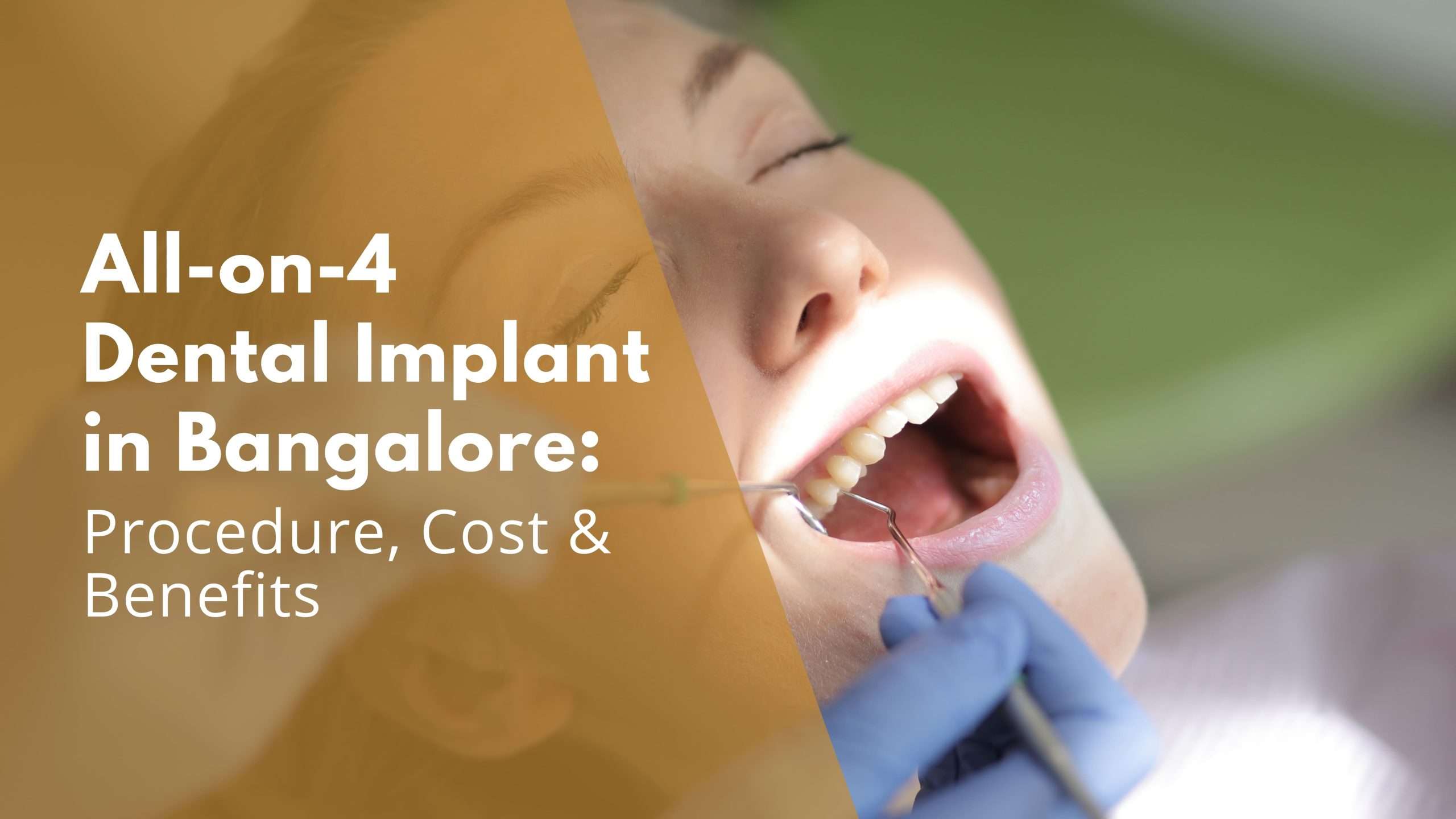 Full Mouth Dental Implants Cost in Bangalore Full Mouth Dental Implants Cost in Bangalore