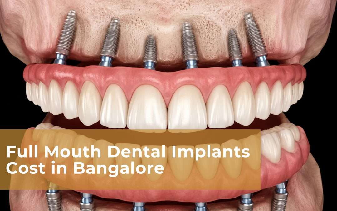 All-on-4 Dental Implants in Bangalore: Procedure, Cost & Benefits