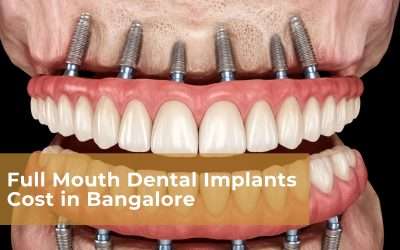 All-on-4 Dental Implants in Bangalore: Procedure, Cost & Benefits
