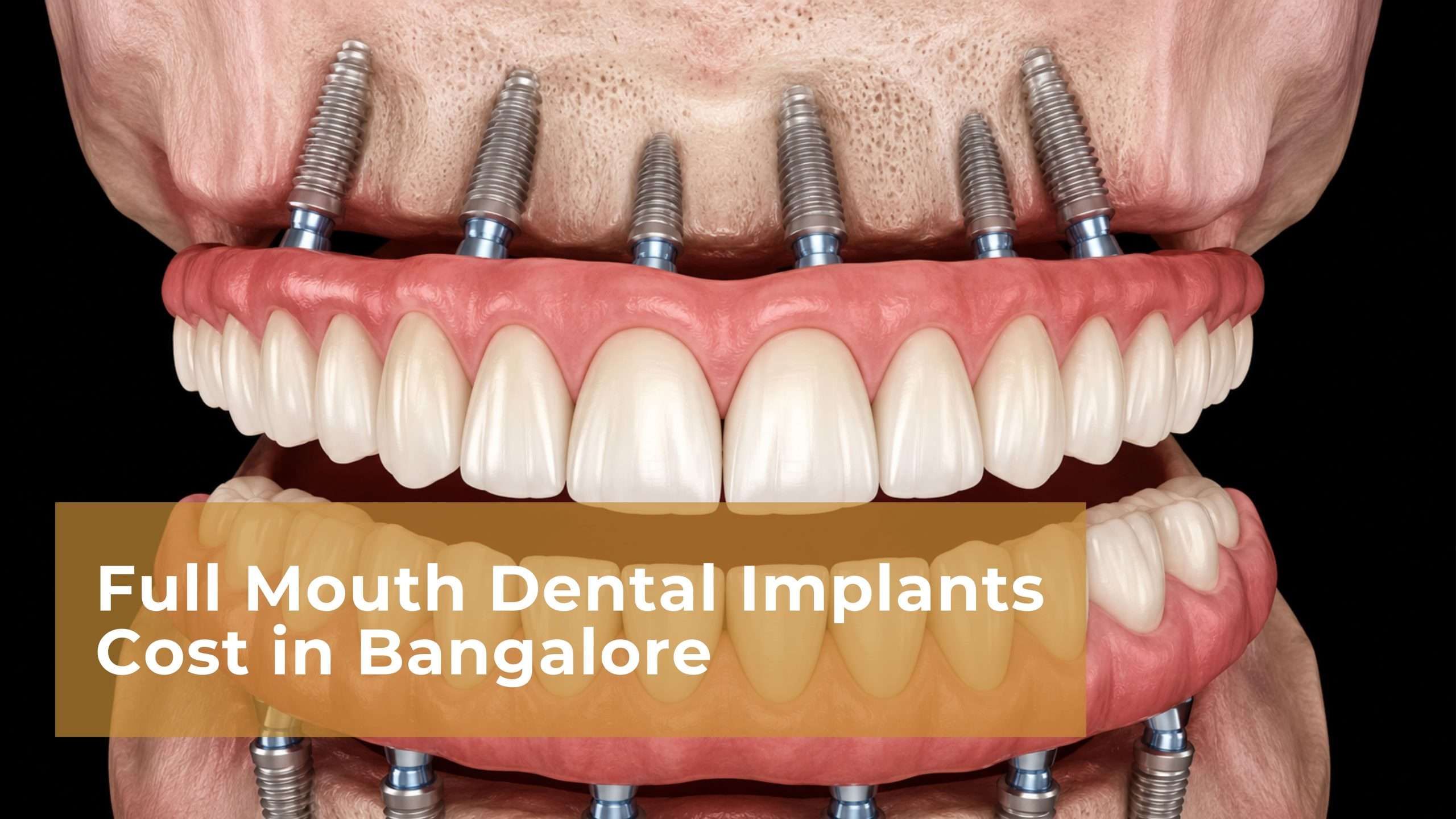 All-on-4 Dental Implants in Bangalore: Procedure, Cost & Benefits