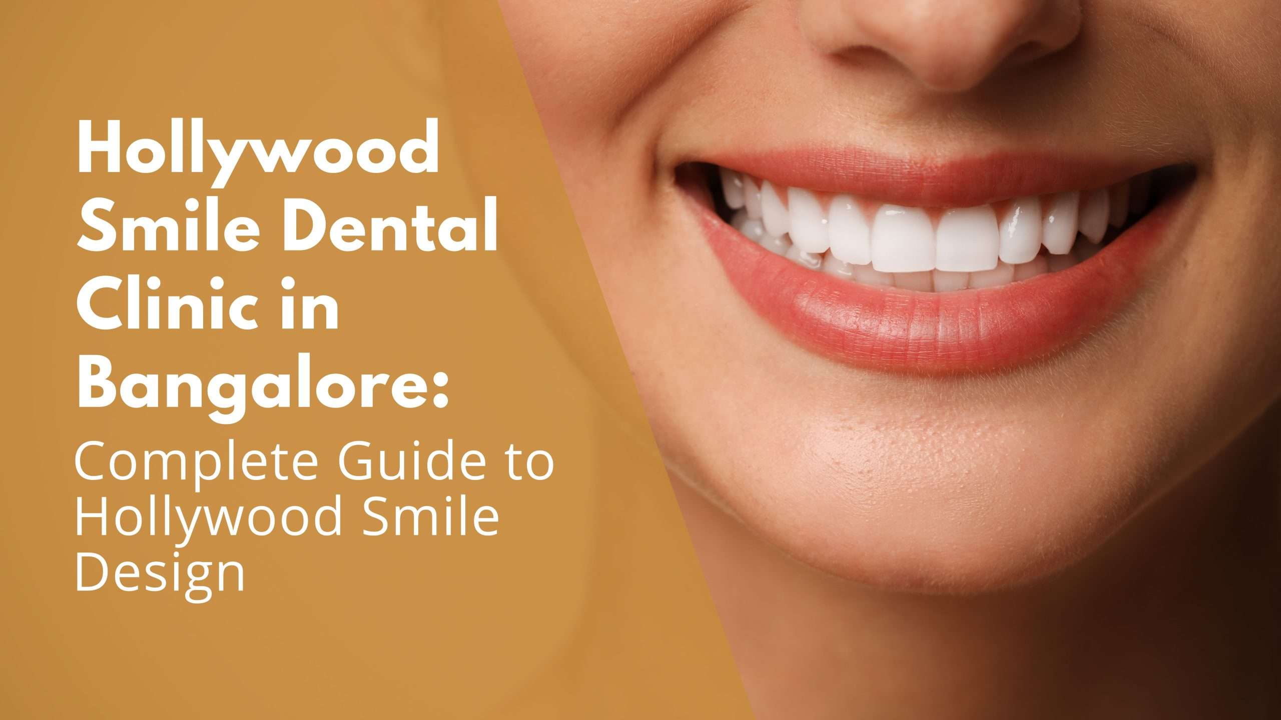Hollywood Smile Dental Clinic in Bangalore: Complete Guide to Hollywood Smile Design Hollywood Smile Dental Clinic in Bangalore: Complete Guide to Hollywood Smile Design